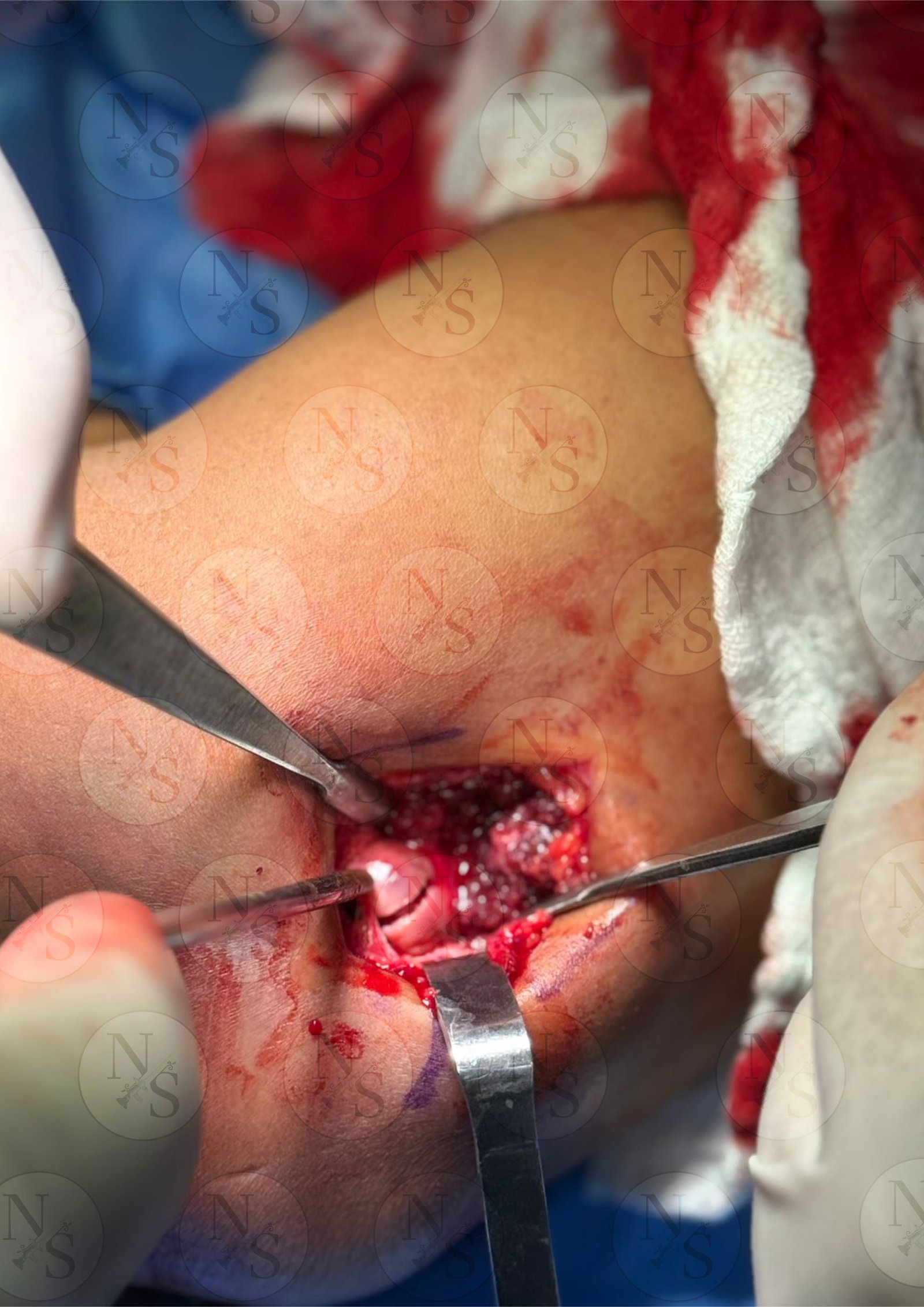 Imagen antes de reduccion de fractura de cupula radial en codo