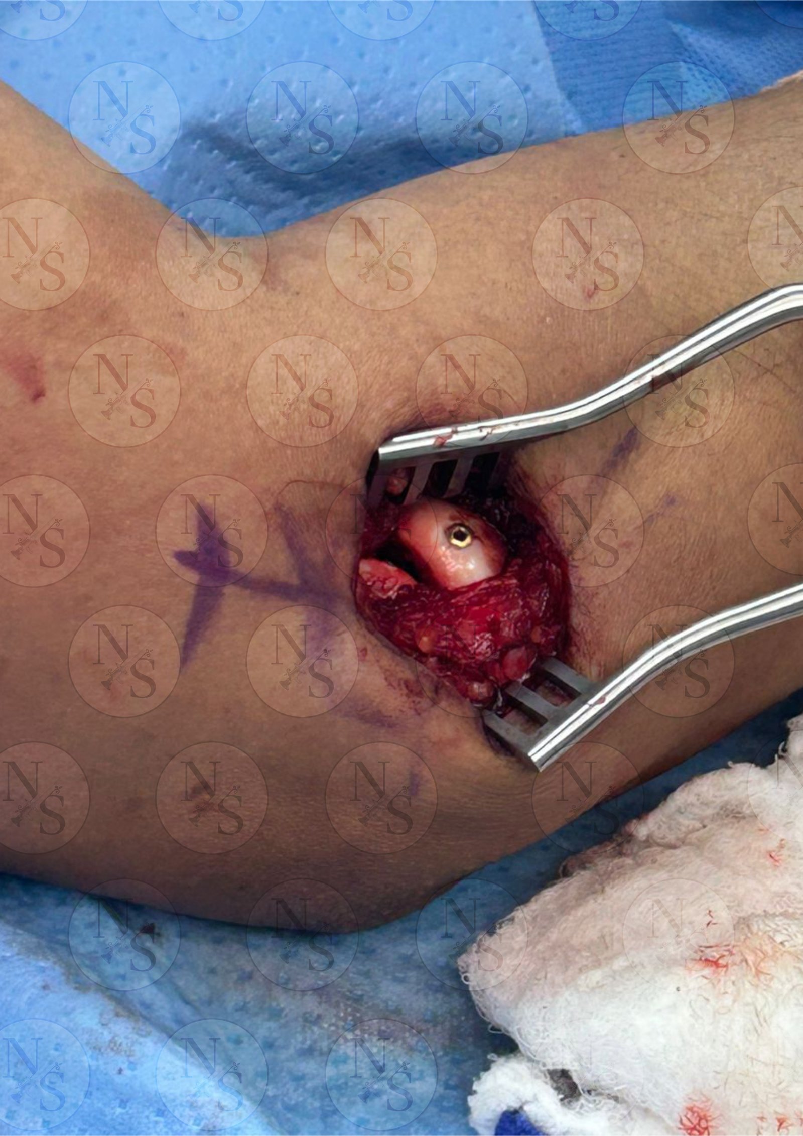 Imagen despues de reduccion de fractura de cupula radial en codo