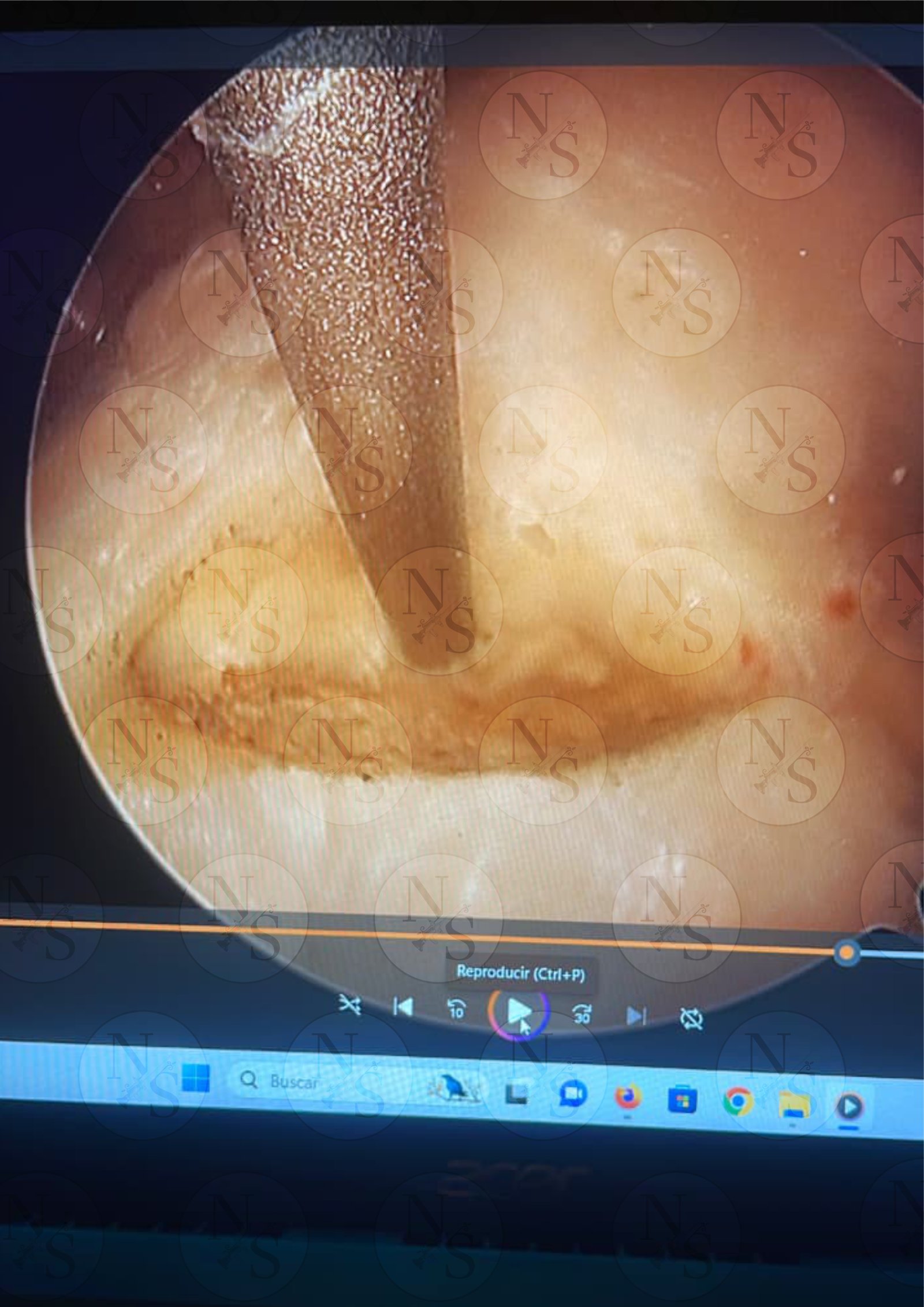 Imagen artroscopica antes de reparacion por lesion de manguito rotador