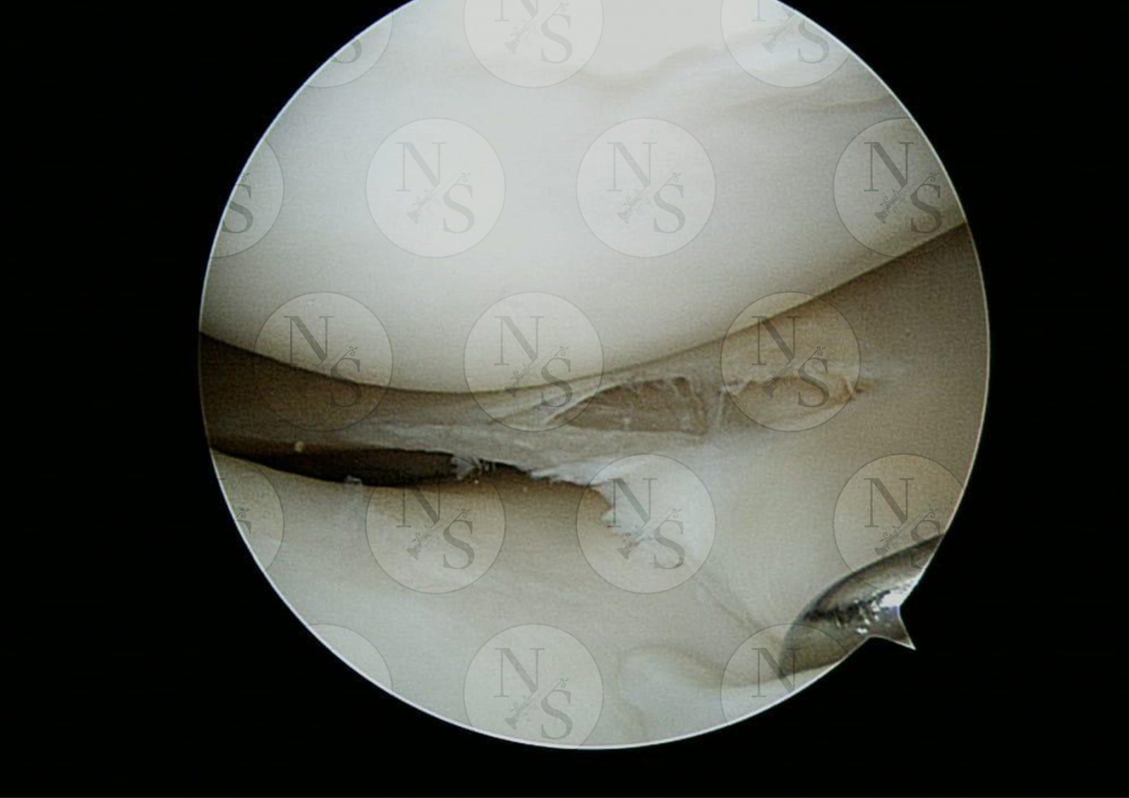 Imagen artroscopica antes del tratamiento por ruptura meniscal